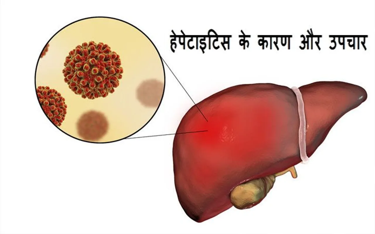 World Hepatitis Day : हेपेटाइटिस को न लें हल्के में, जानें इसके कारण और उपचार, मुफ्त में यहां कराएं इलाज