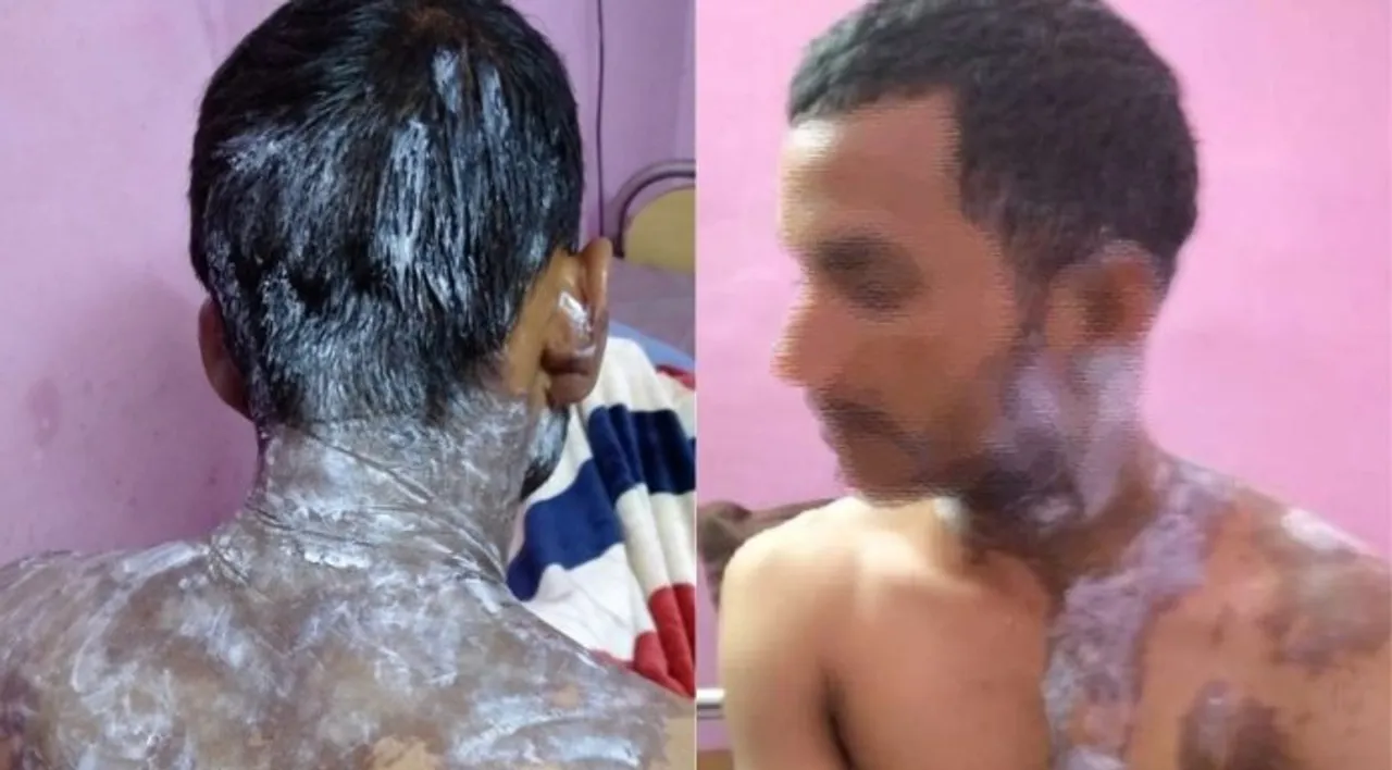 एकतरफा प्यार में मुस्लिम लड़की ने रोहित यादव पर किया तेजाब से हमला, 5 महीने से पड़ी थी पीछे