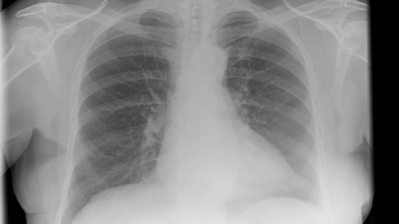 X-ray