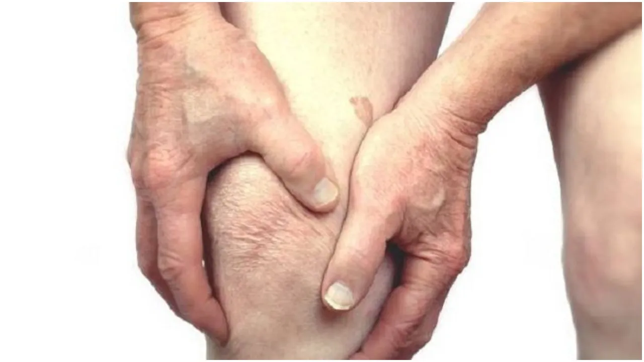 Arthritis
