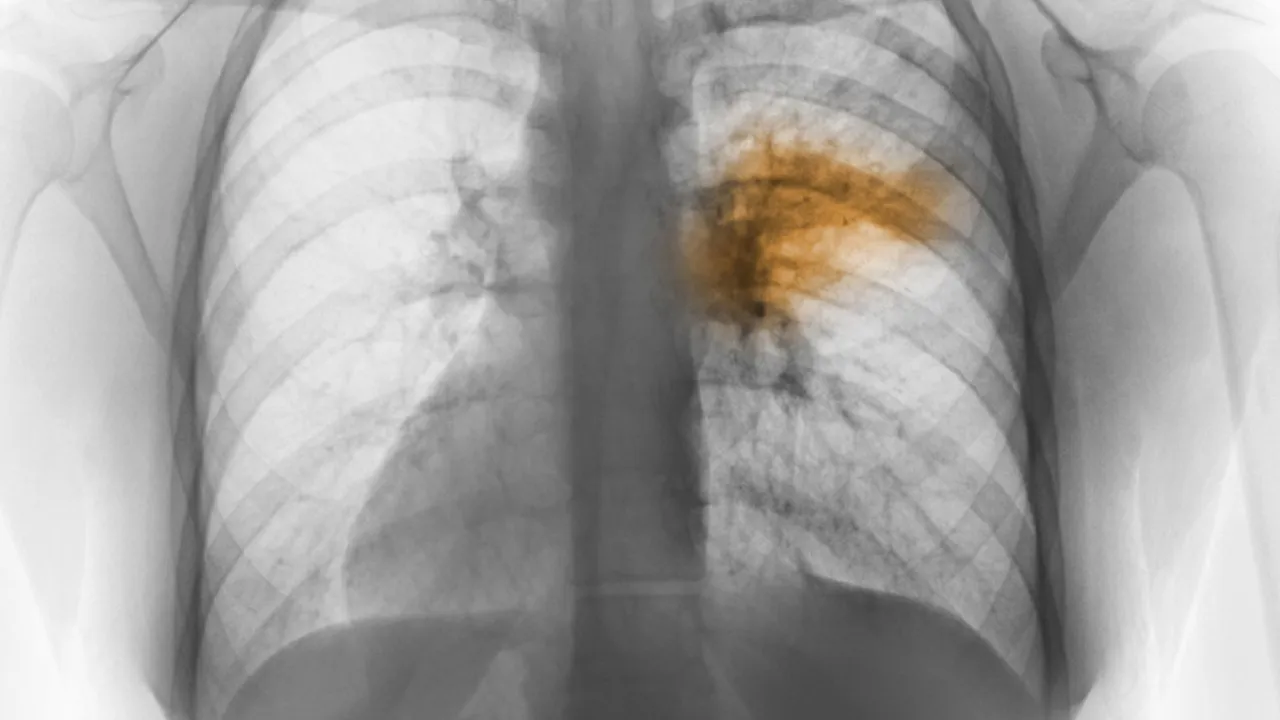 pneumonia new