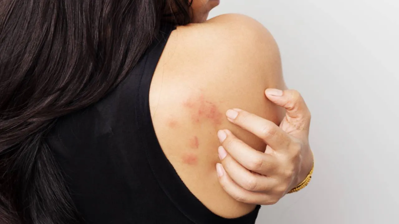 Hives
