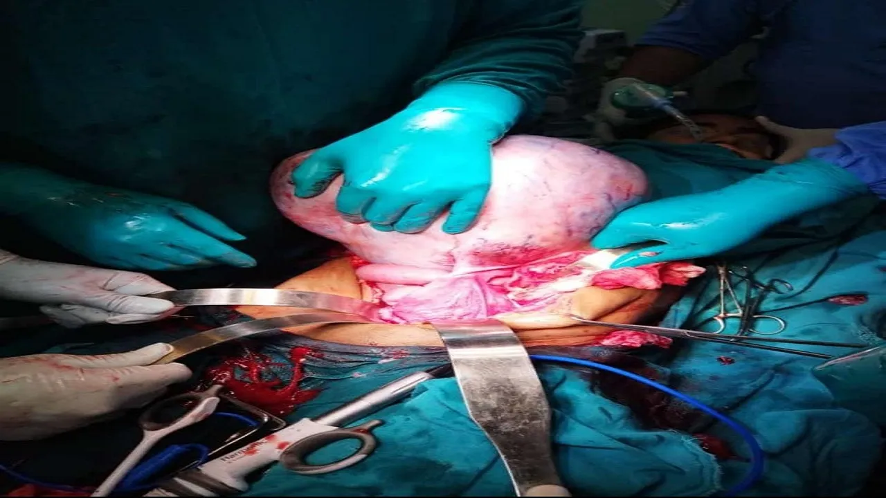 Ovarian tumor