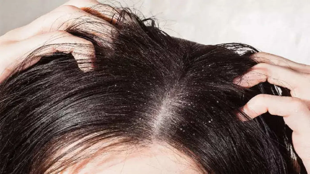 Hair Dandruff