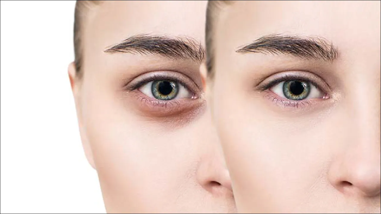 Dark Circles
