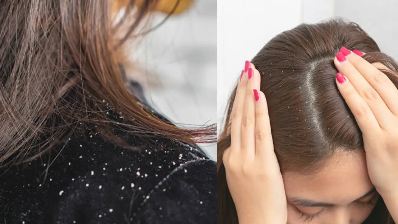 Home remedies for hair dandruff
