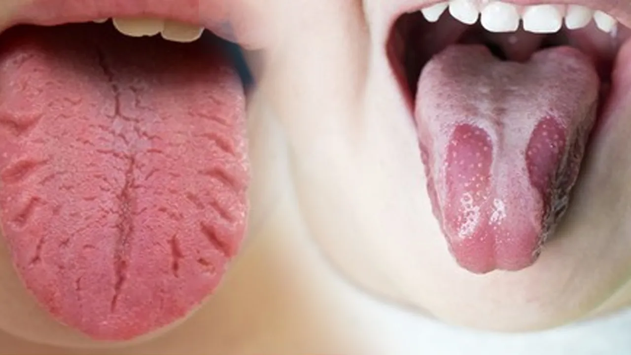 Tongue burn remedy