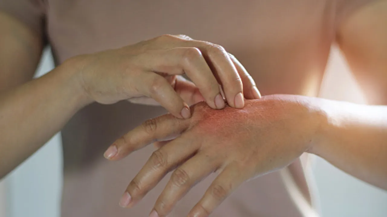 Skin itching home remedies