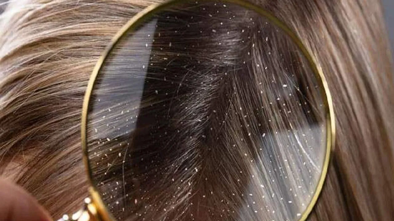 Dandruff