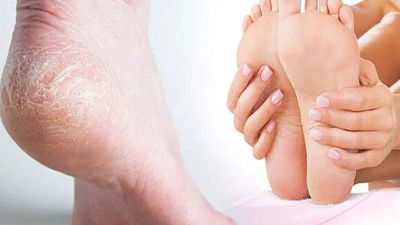 Cracked heels