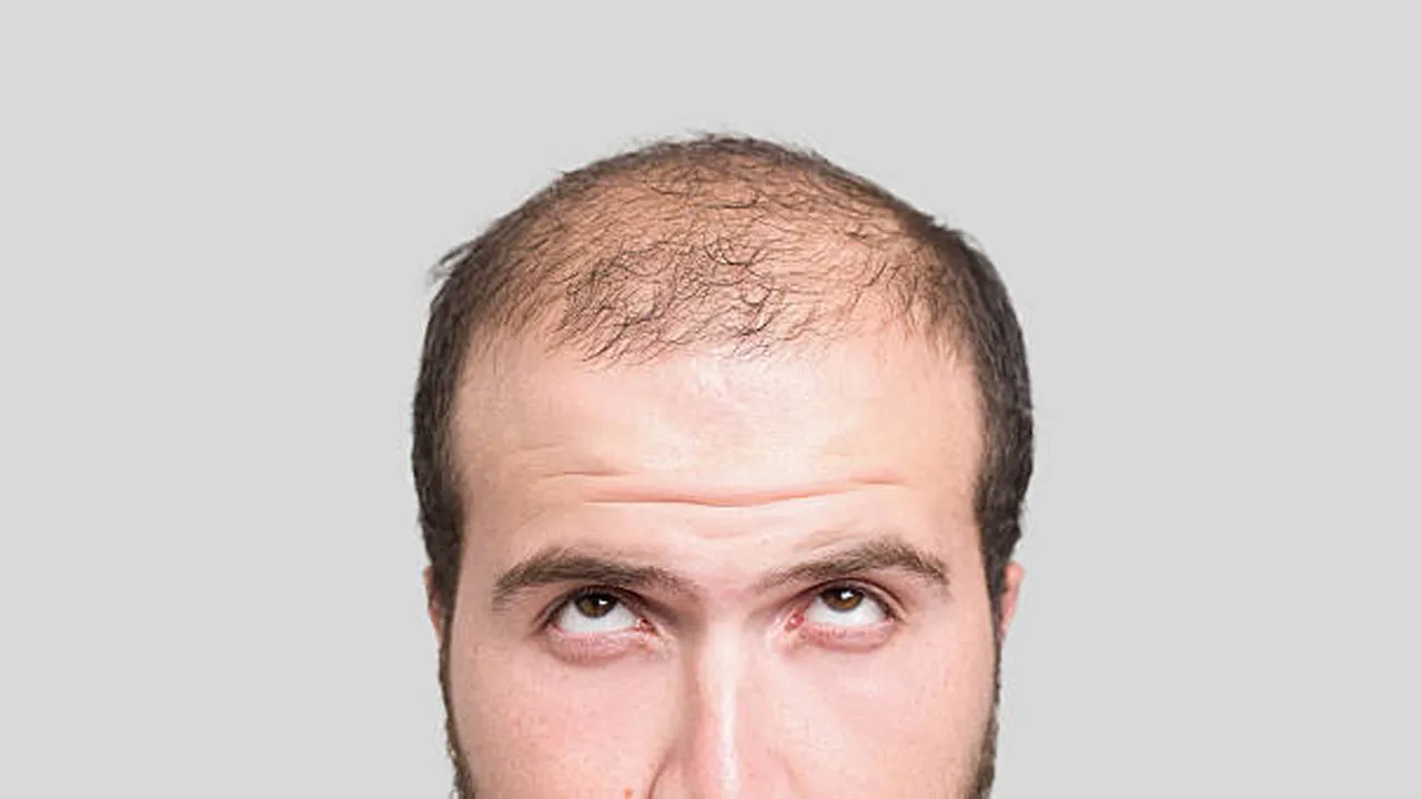 Baldness