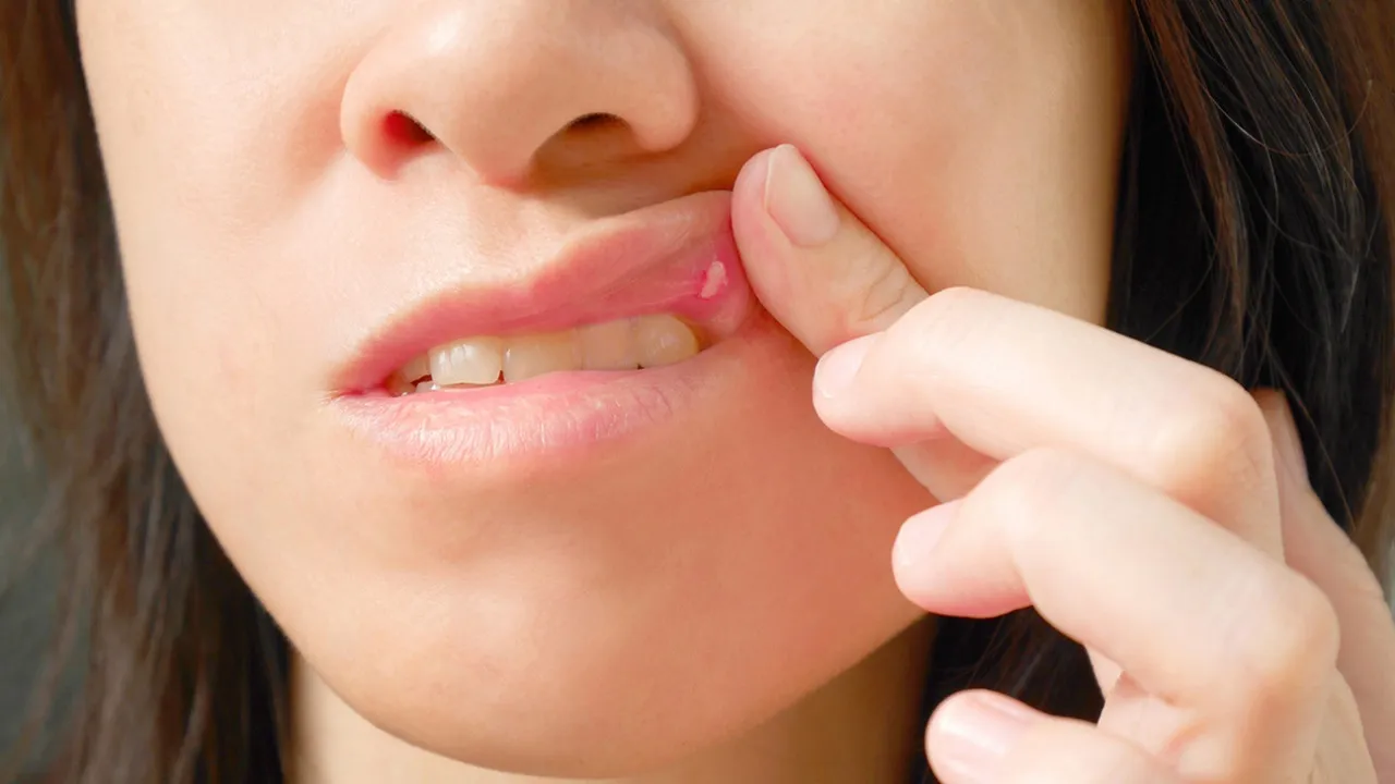 mouth ulcer