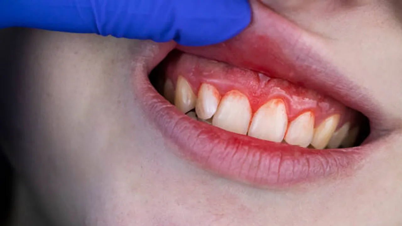 Bleeding gums home remedy