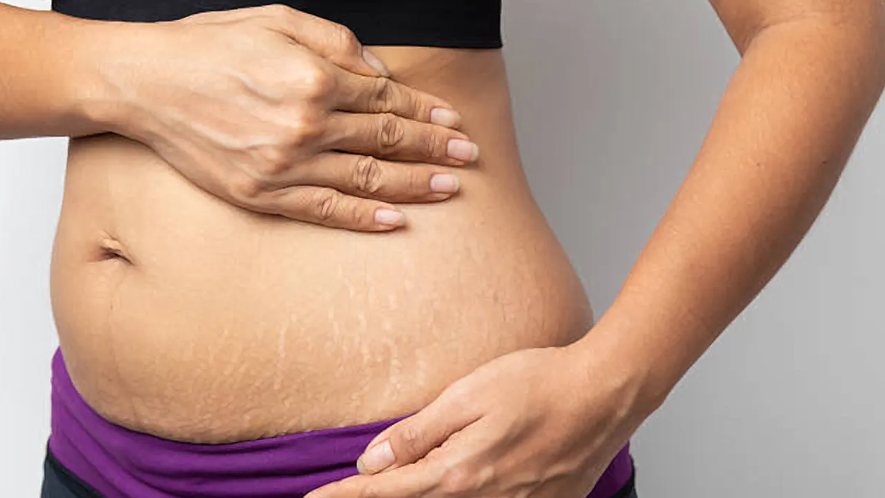 home remedies for stretch marks