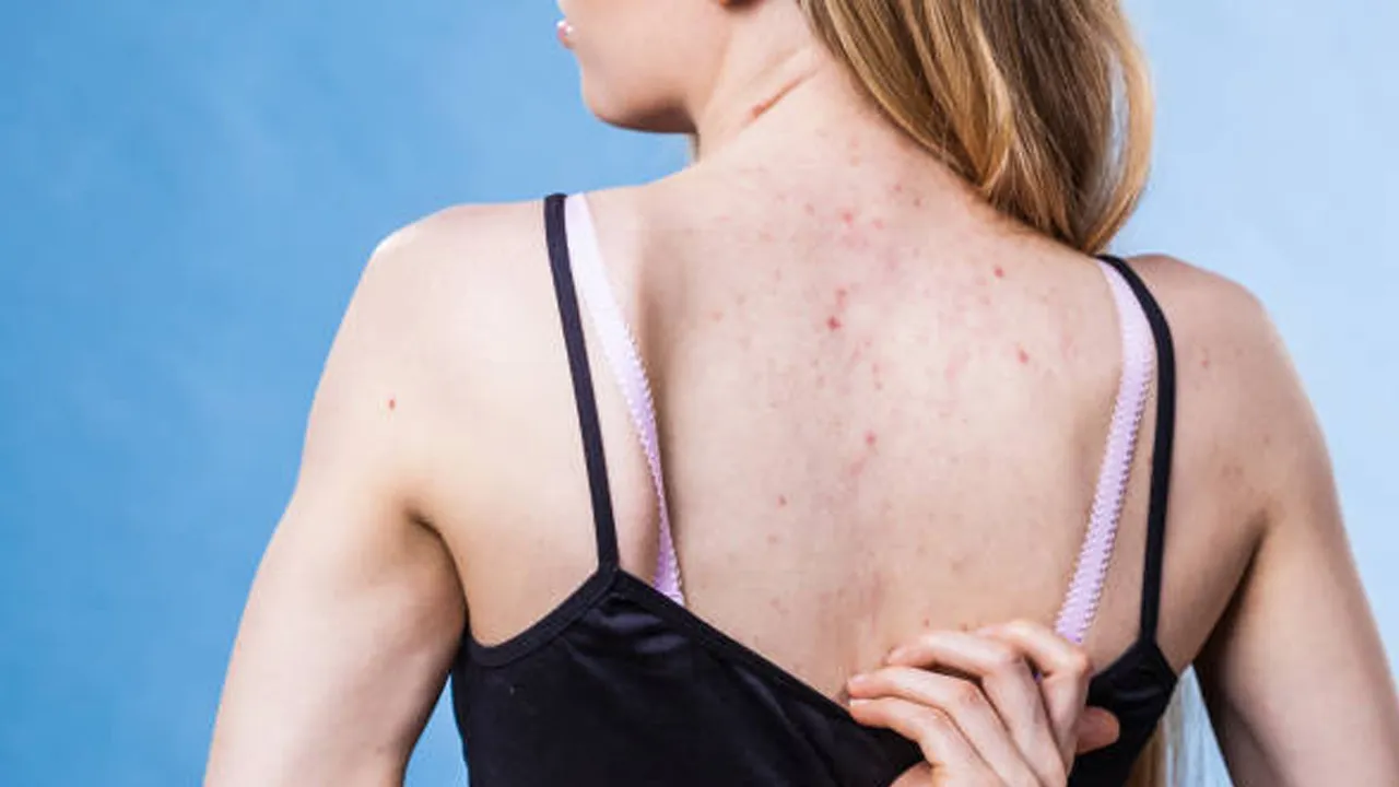 Back acne treatment