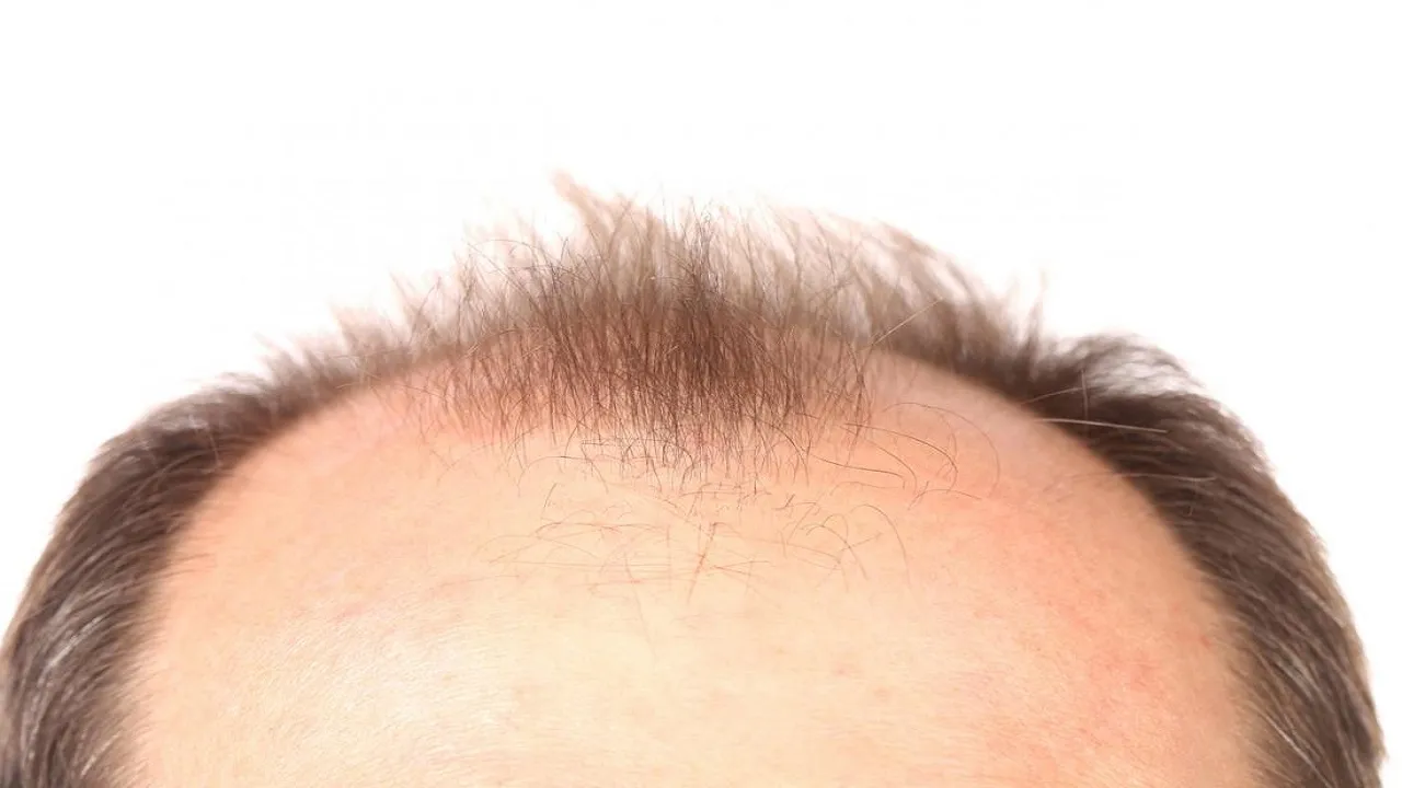 bald