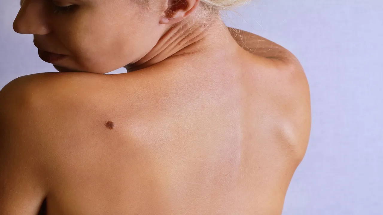 Birthmark Meaning