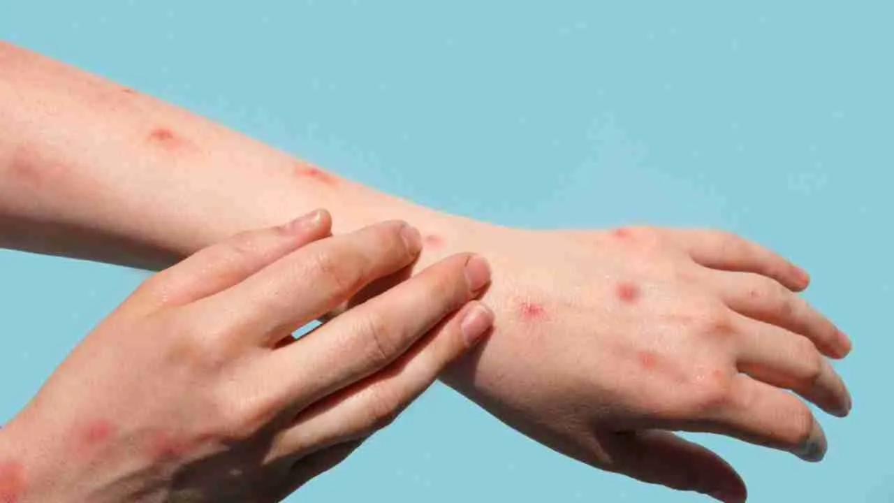 monkeypox1  1