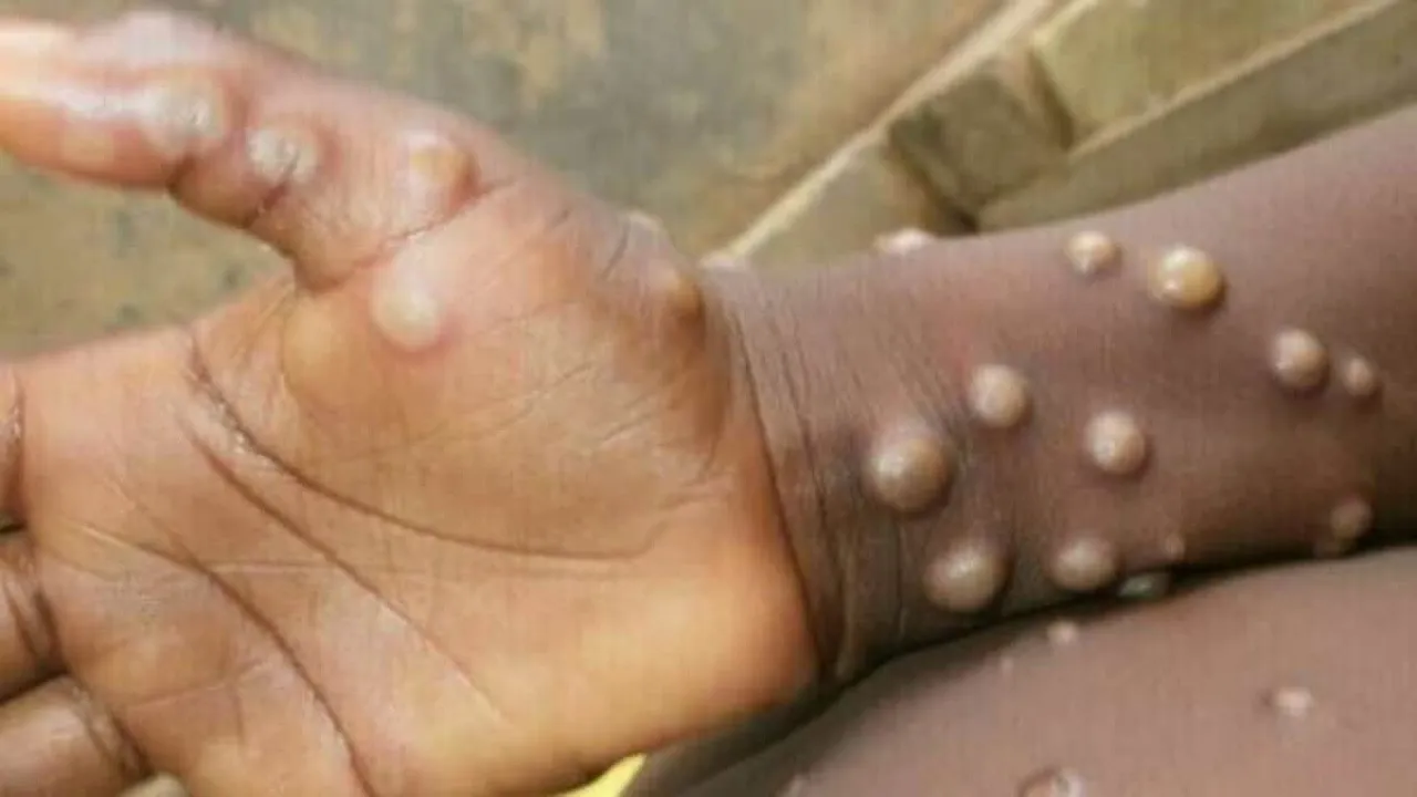 monkeypox