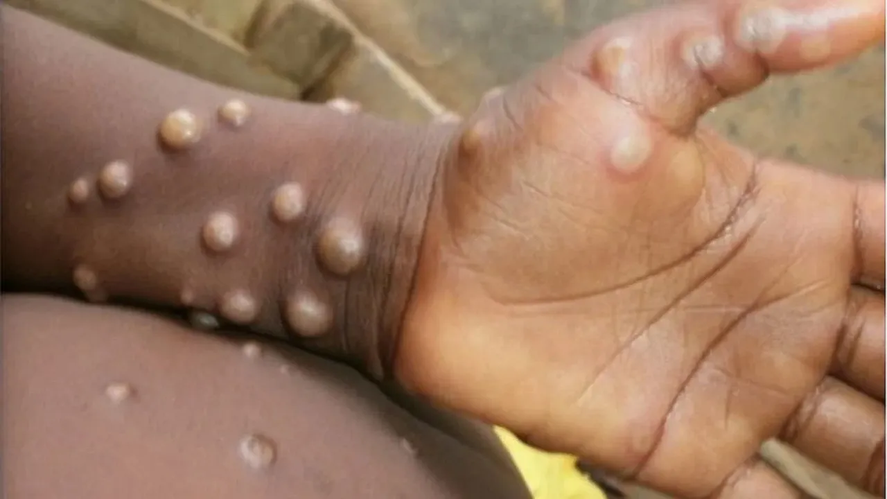 monkey pox