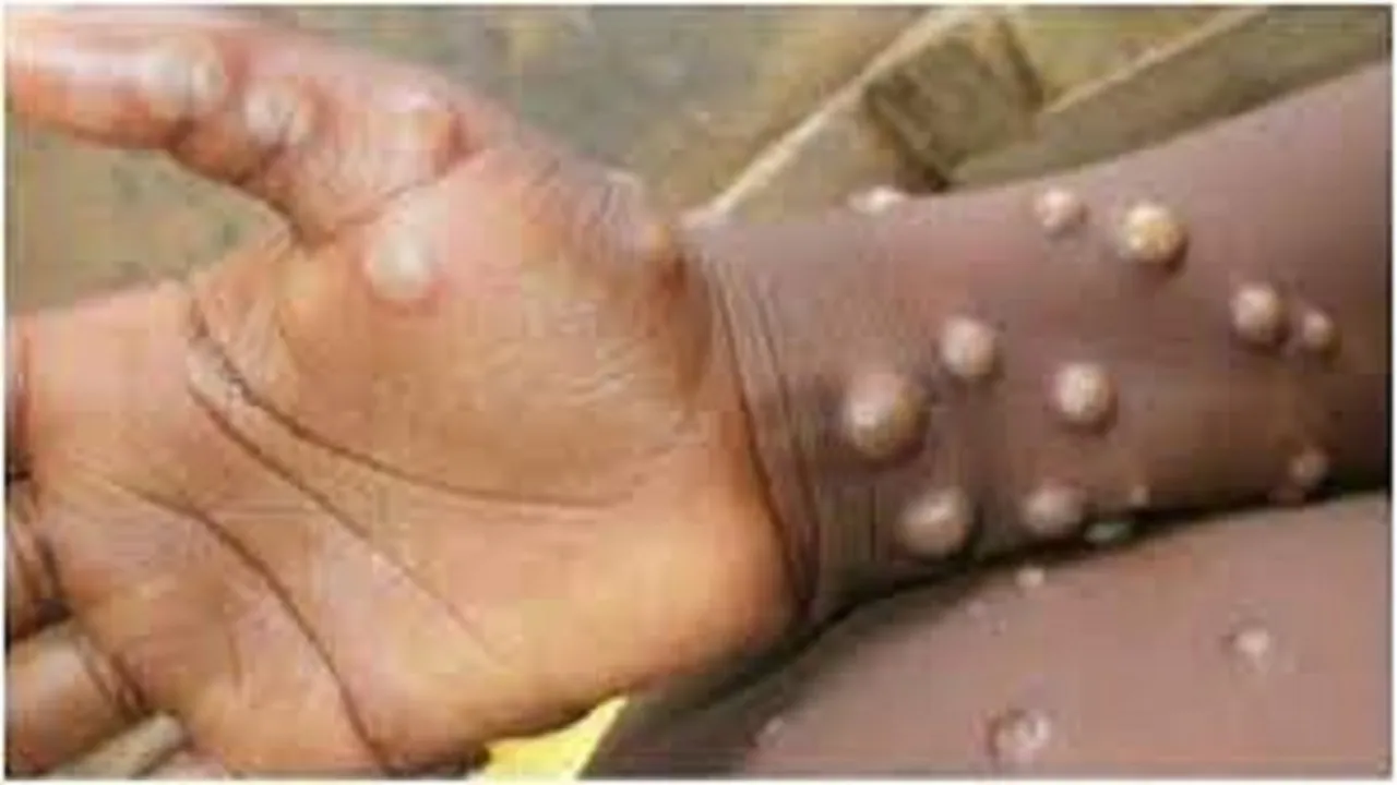 monkey pox