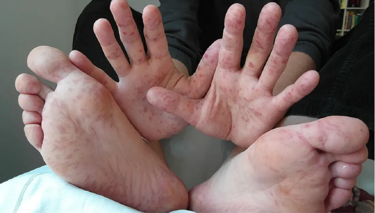 Hand Fooot Mouth