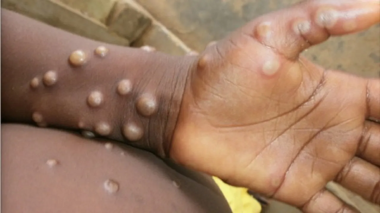 monkey pox