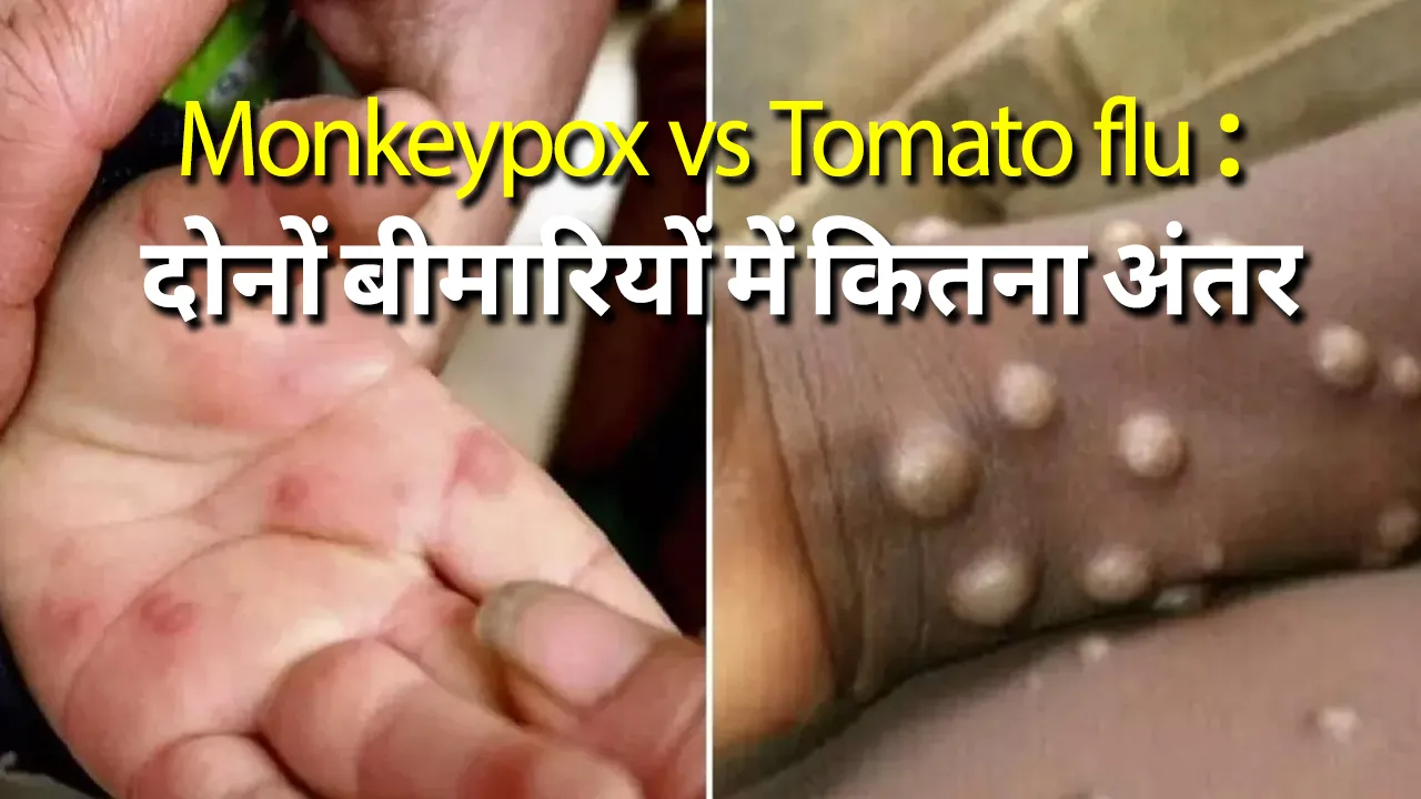 monkeypox