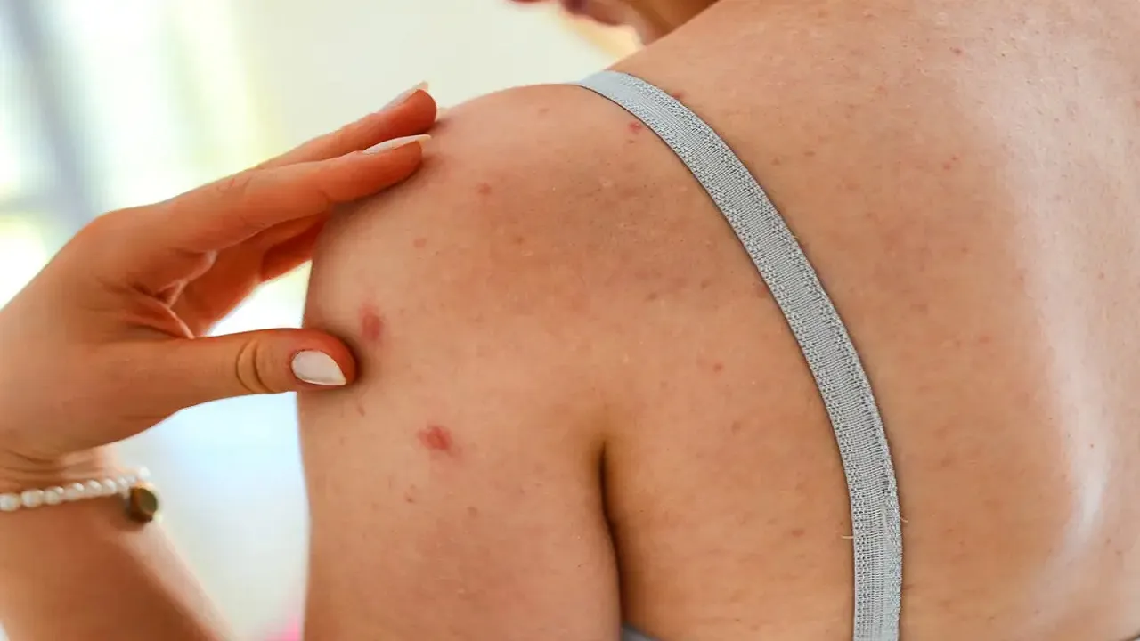 Treatment Of Bacne