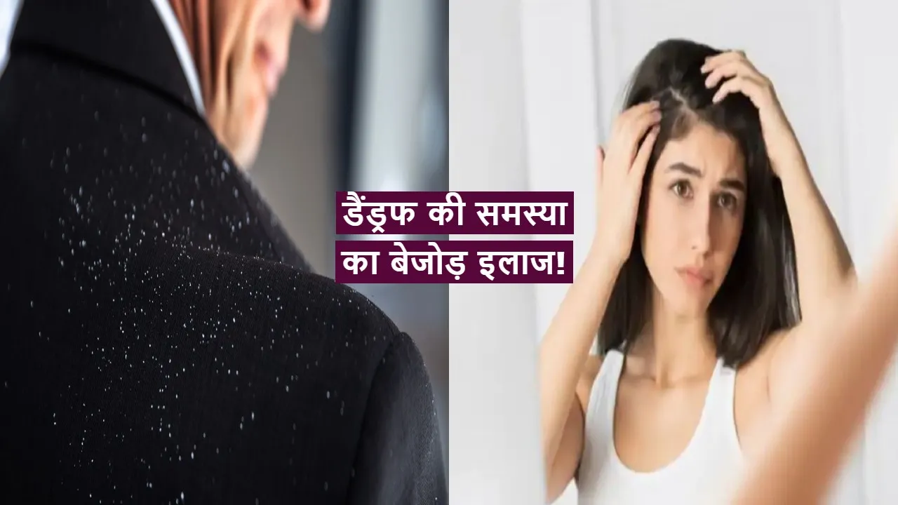 Dandruff In Winter