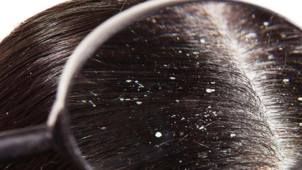 Dandruff Treatment At Home