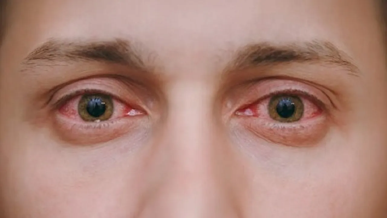 Diabetic retinopathy