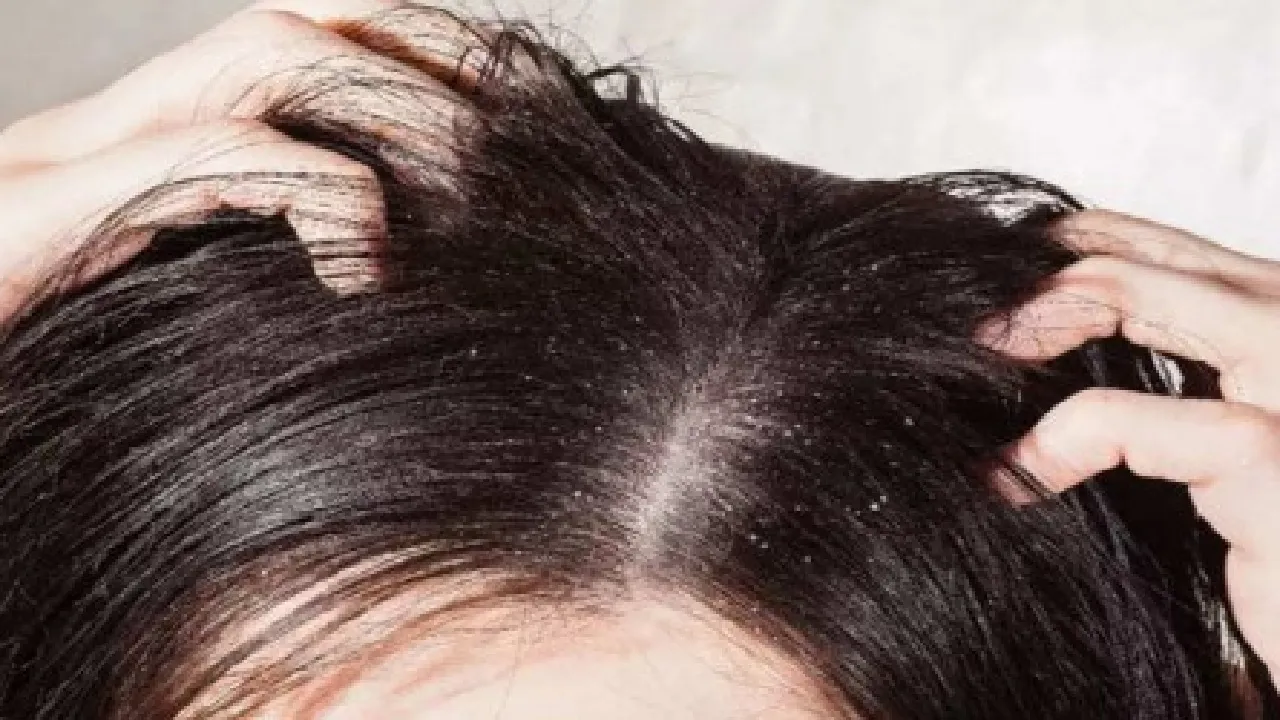 dandruff in summer