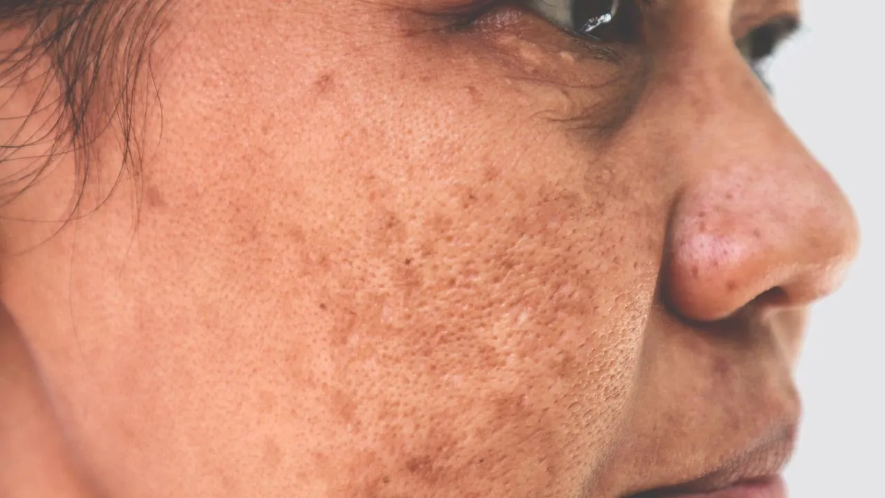 Hyperpigmentation