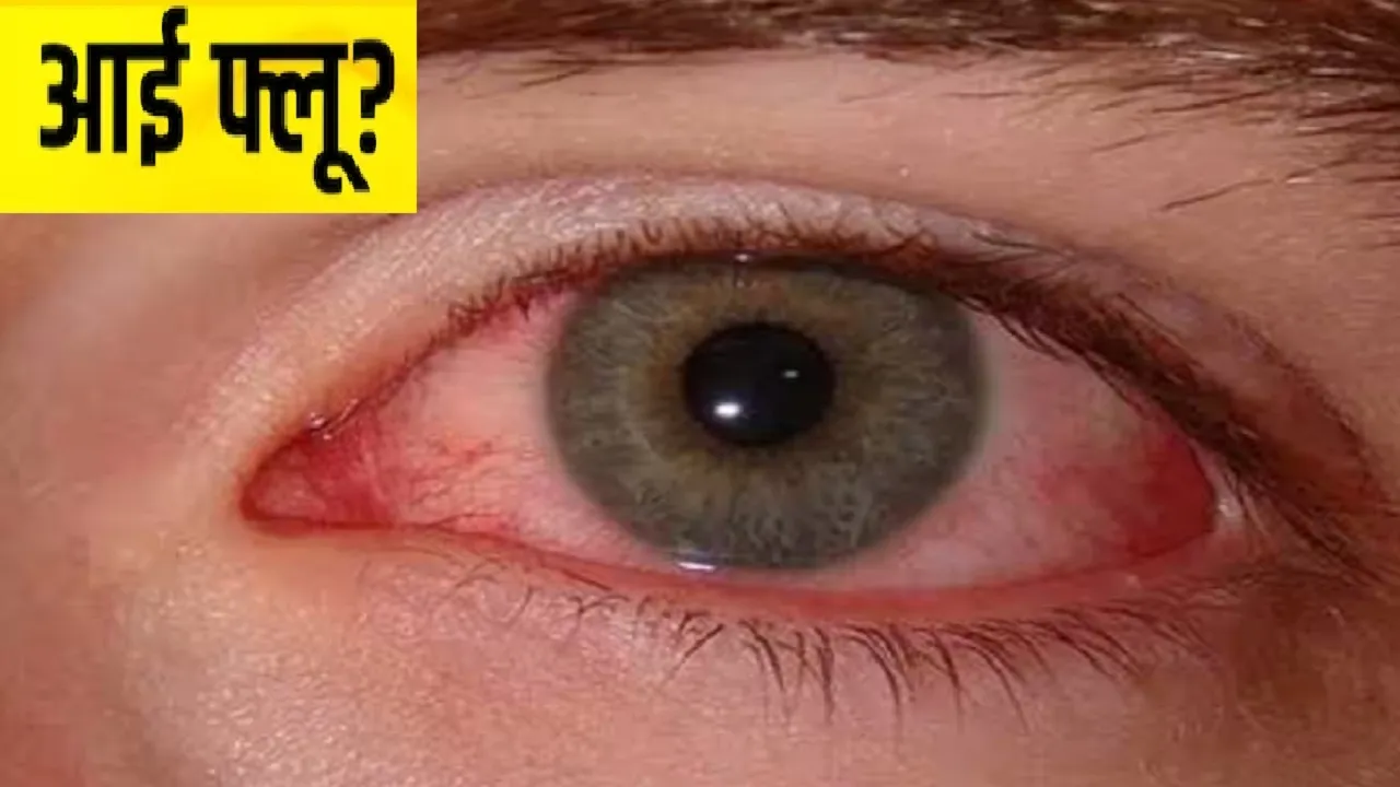 Eye Flu