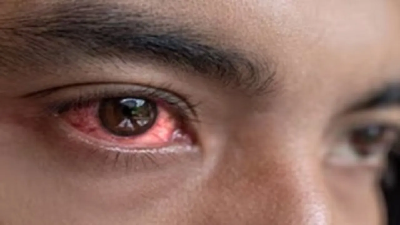 eye flu