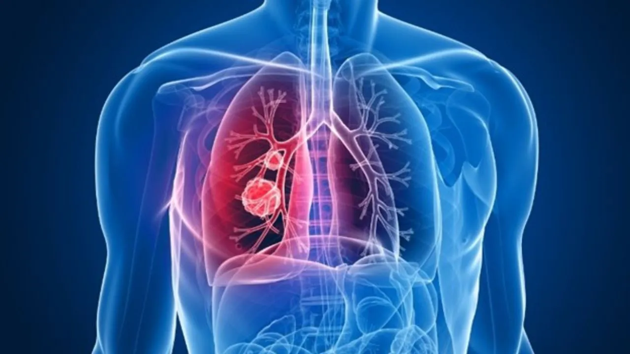Lung Cancer