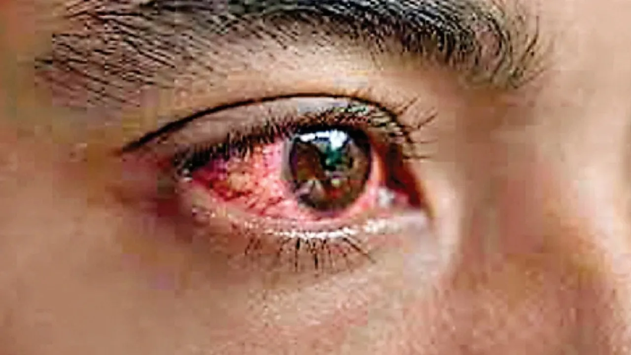 eye flu remedy