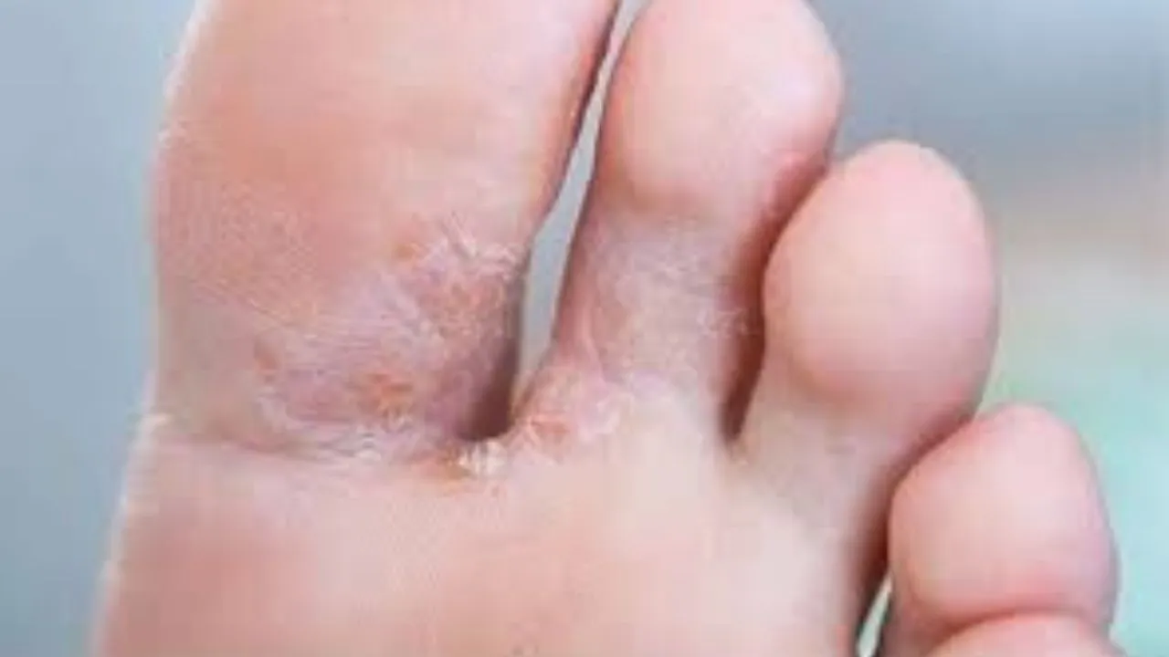 fungal infection