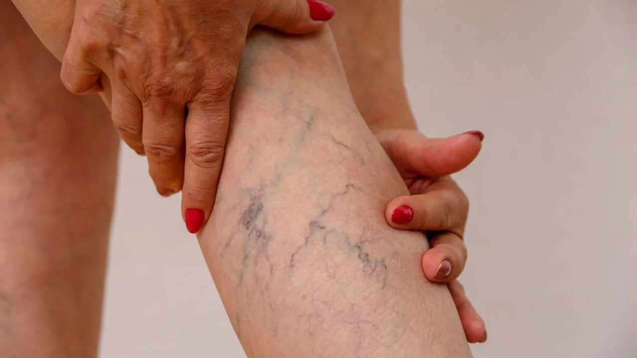 varicose-veins