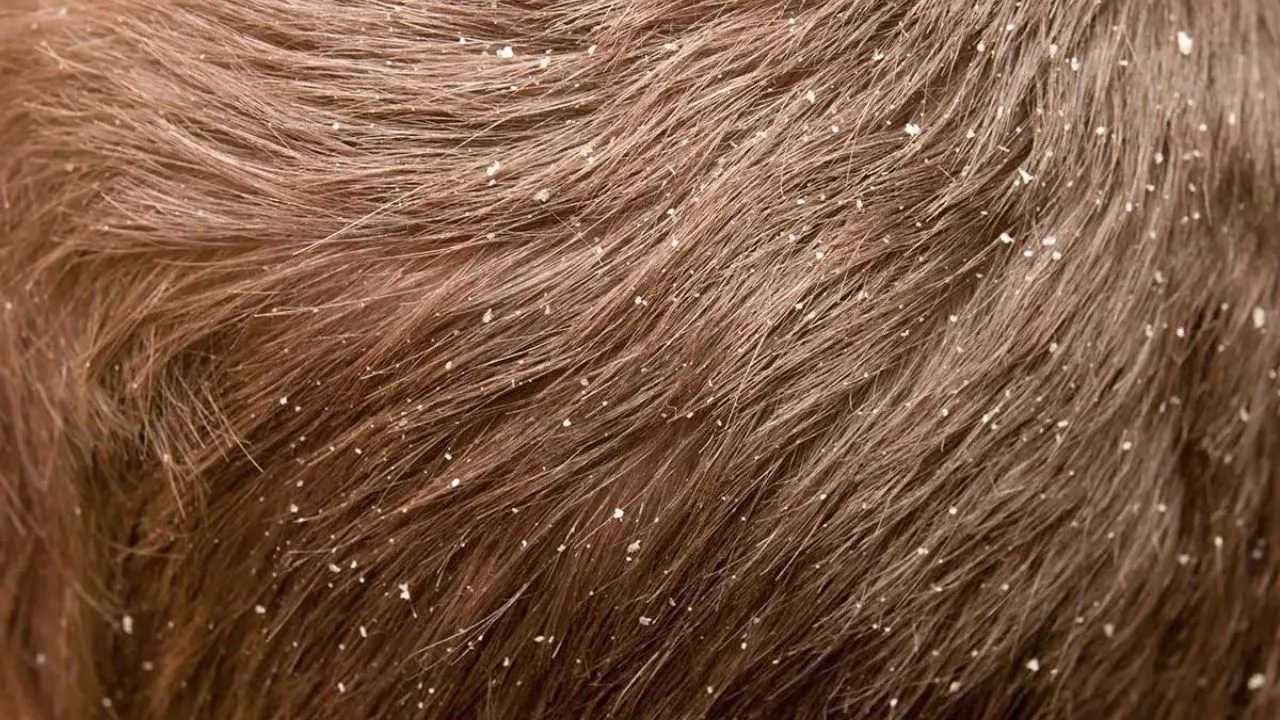 dandruff