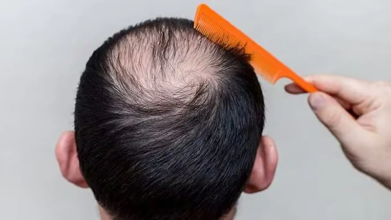 baldness tips