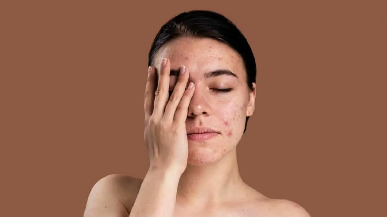 Pimples on Face