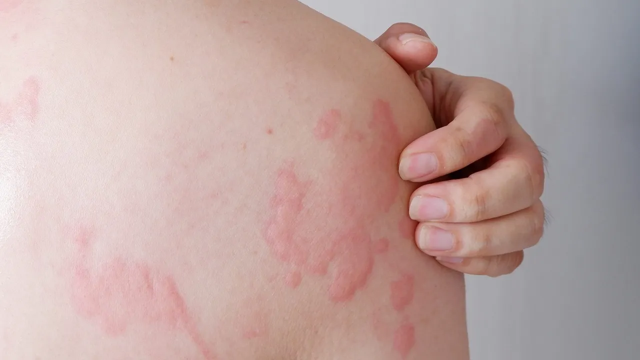 aquagenic urticaria symptoms