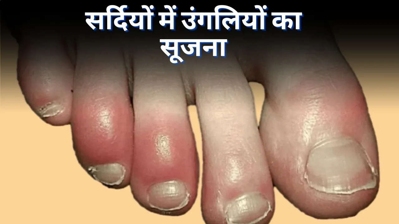 swelling of fingers and toes in winter