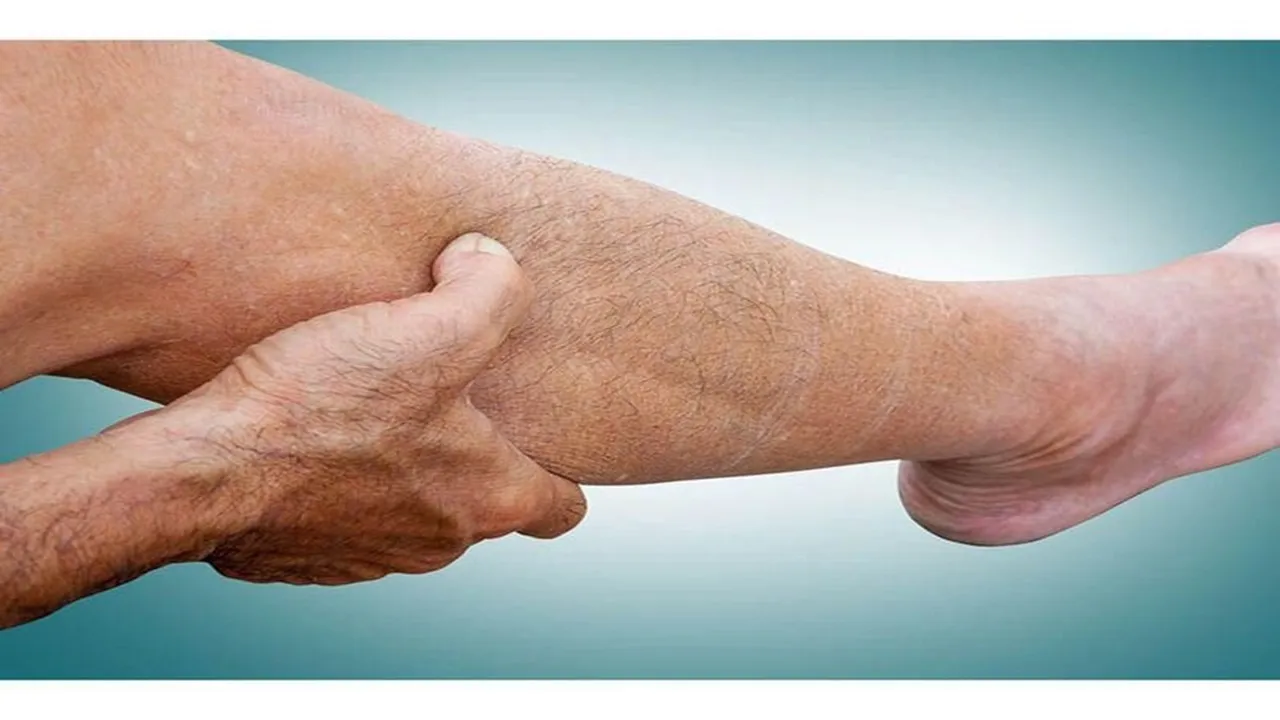 Peripheral Artery Disease