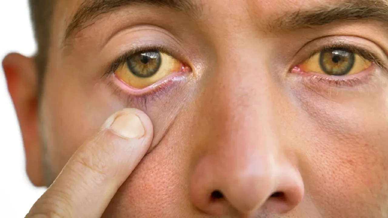 Symptoms of Jaundice