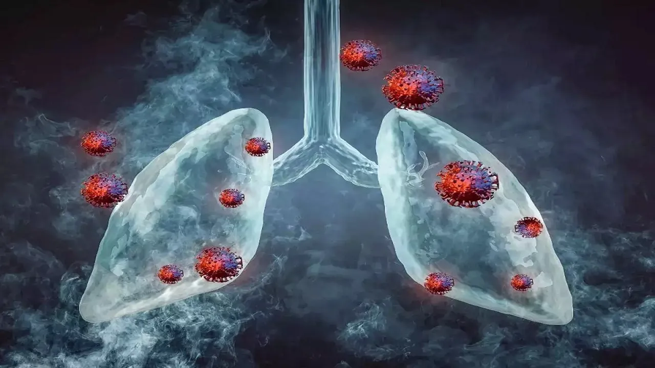 Tuberculosis