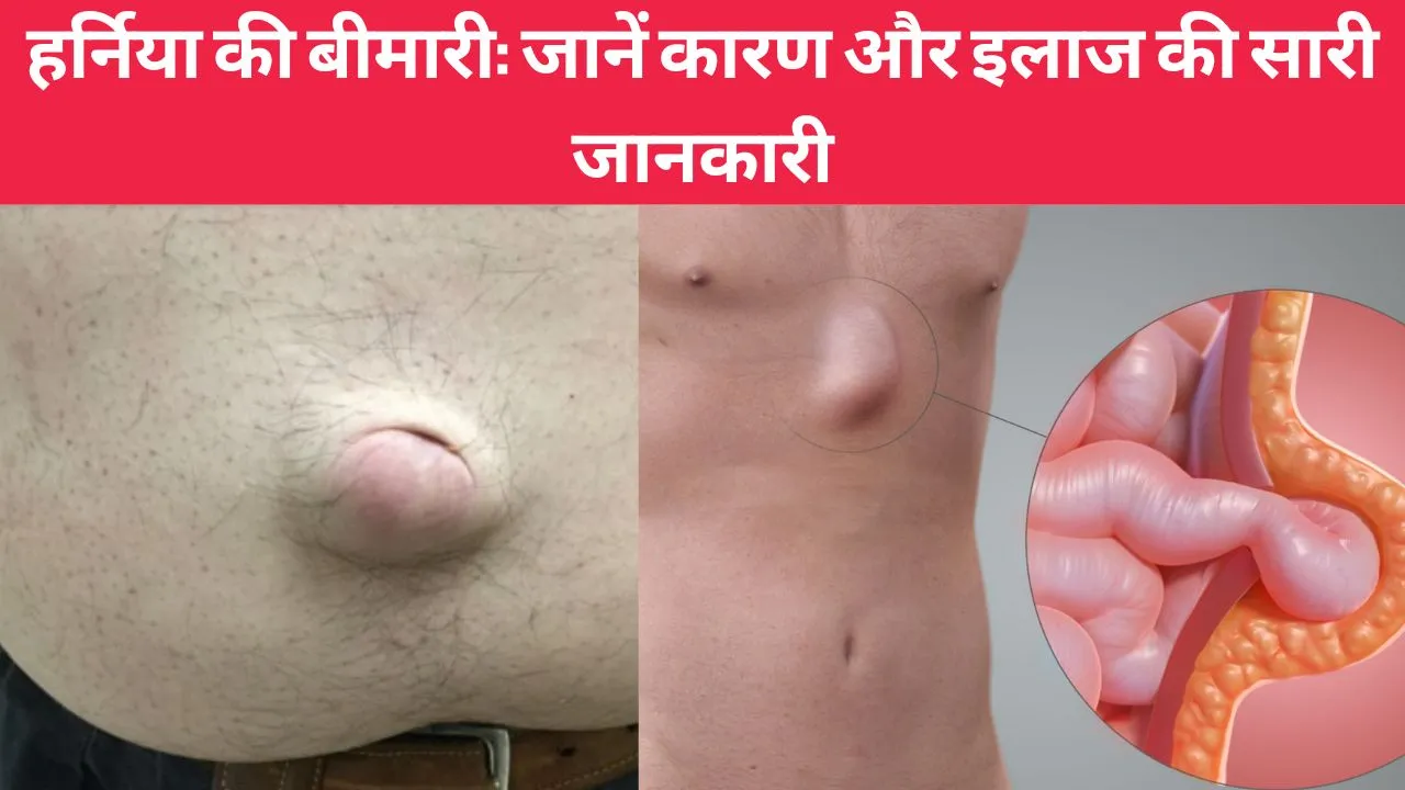 Hernia disease