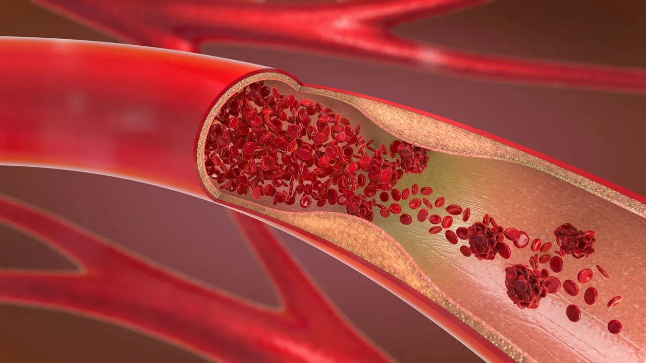 Thrombosis Disease